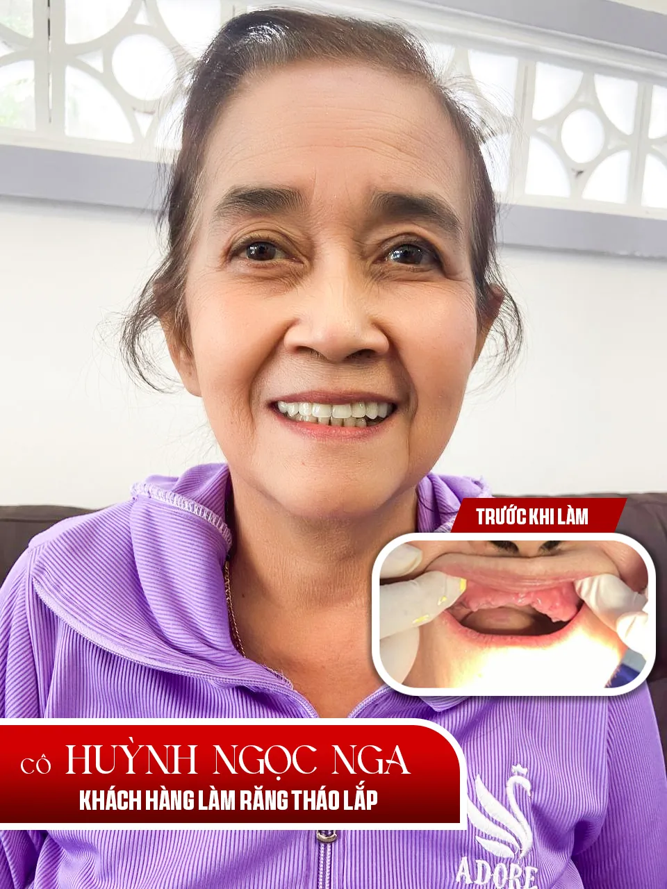 Cấy ghép implant
