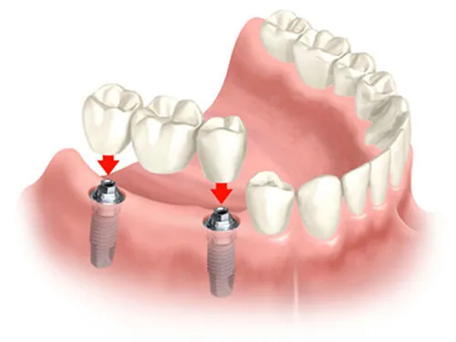 Cấy ghép implant