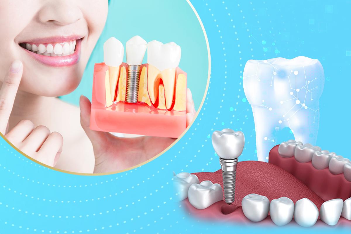 Trồng Răng Implant Tại Nha Khoa Sài Gòn 3M: Giải Pháp Hoàn Hảo Khôi Phục Nụ Cười Tự Tin