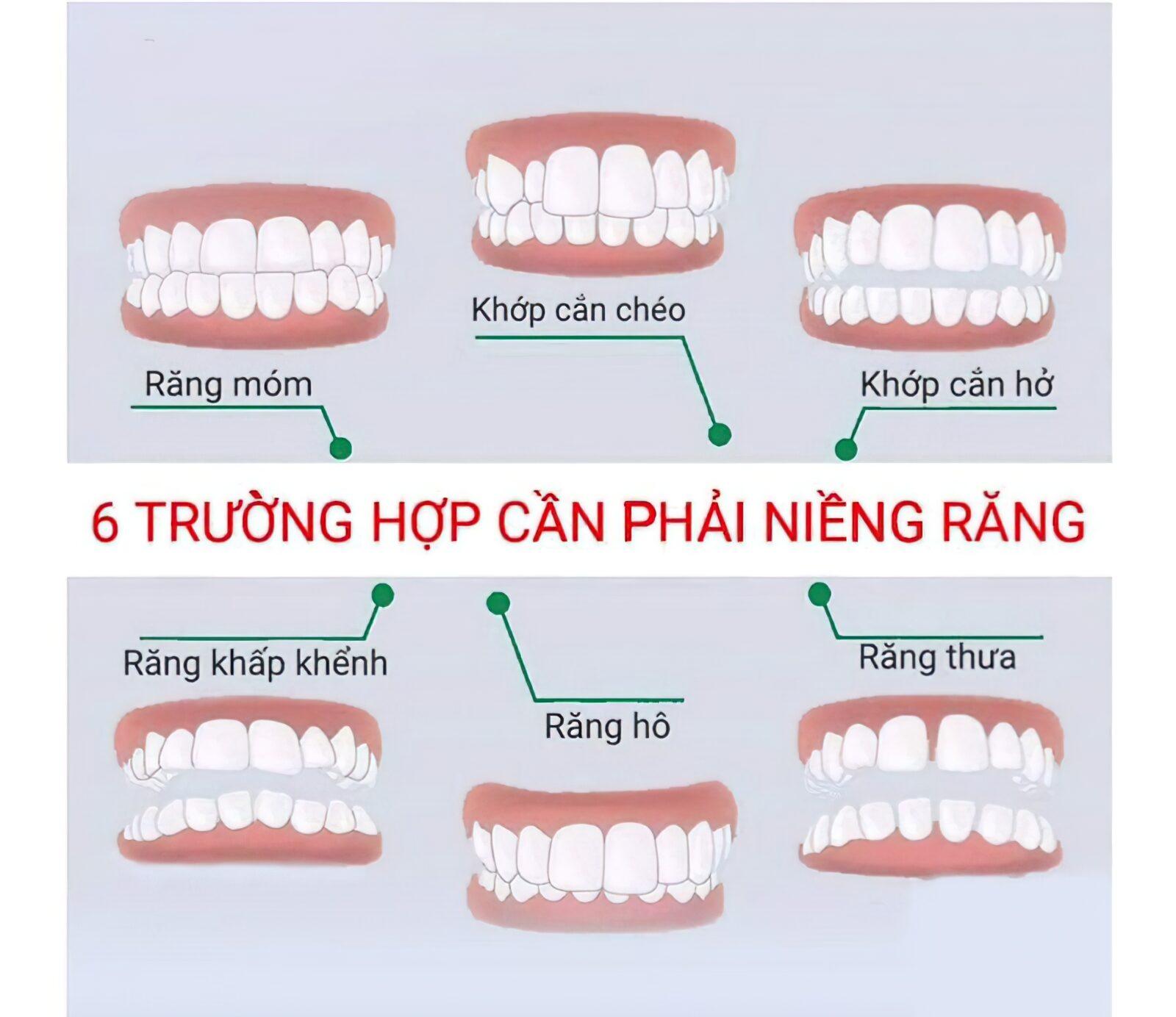 NIỀNG RĂNG THẨM MỸ – GIẢI PHÁP CHO NỤ CƯỜI HOÀN HẢO