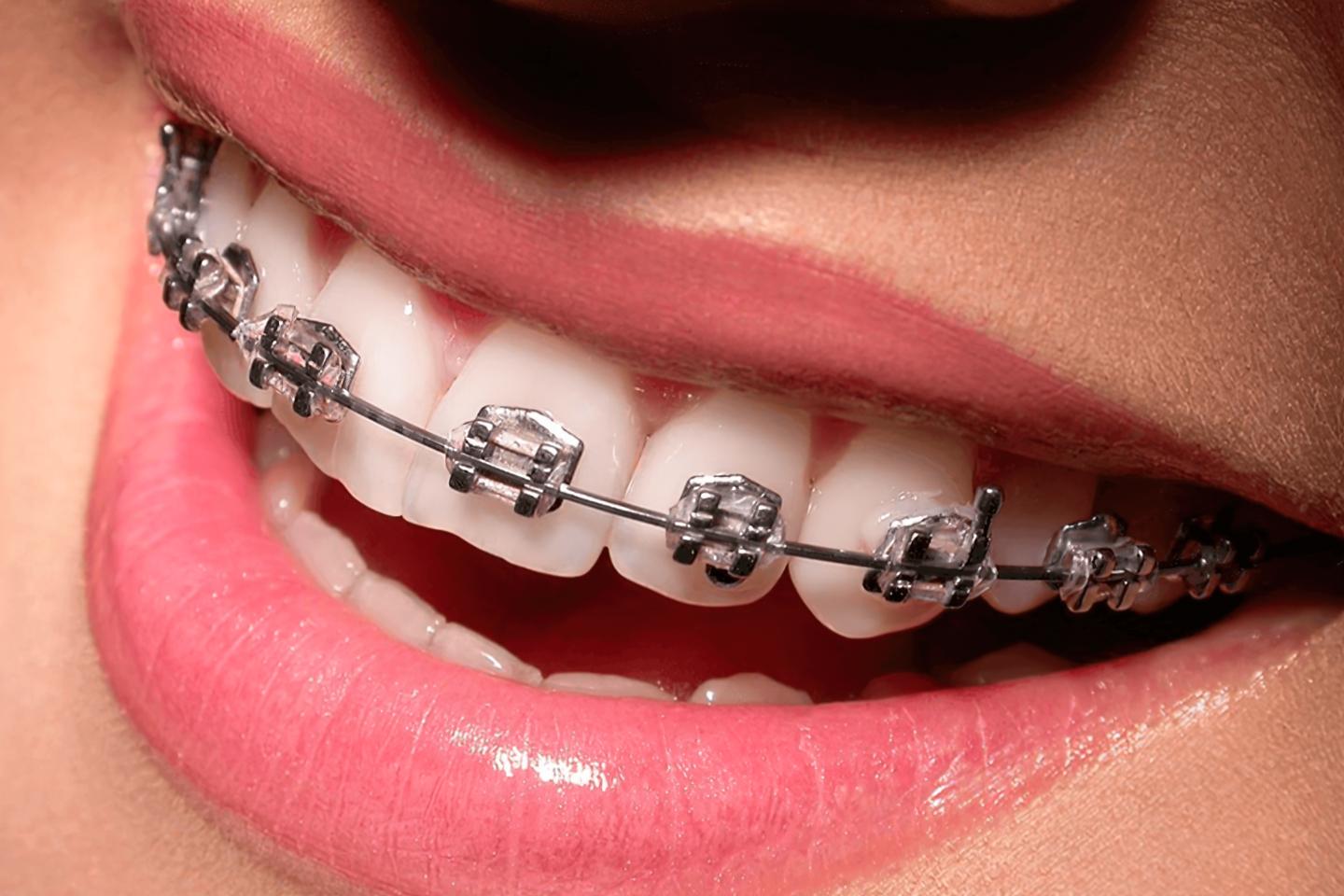 NIỀNG RĂNG THẨM MỸ – GIẢI PHÁP CHO NỤ CƯỜI HOÀN HẢO