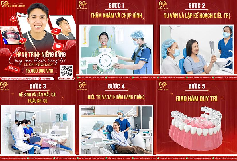 NIỀNG RĂNG THẨM MỸ – GIẢI PHÁP CHO NỤ CƯỜI HOÀN HẢO