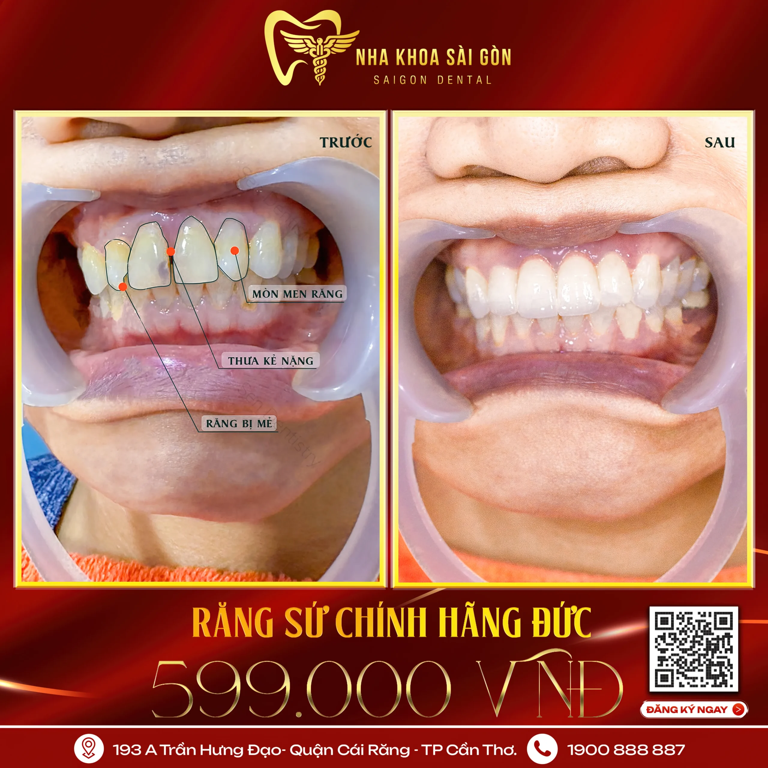 Răng sứ thẩm mỹ