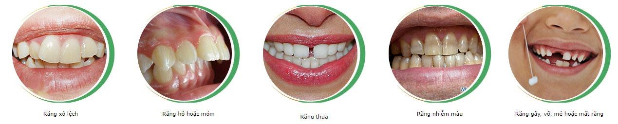 Răng sứ thẩm mỹ
