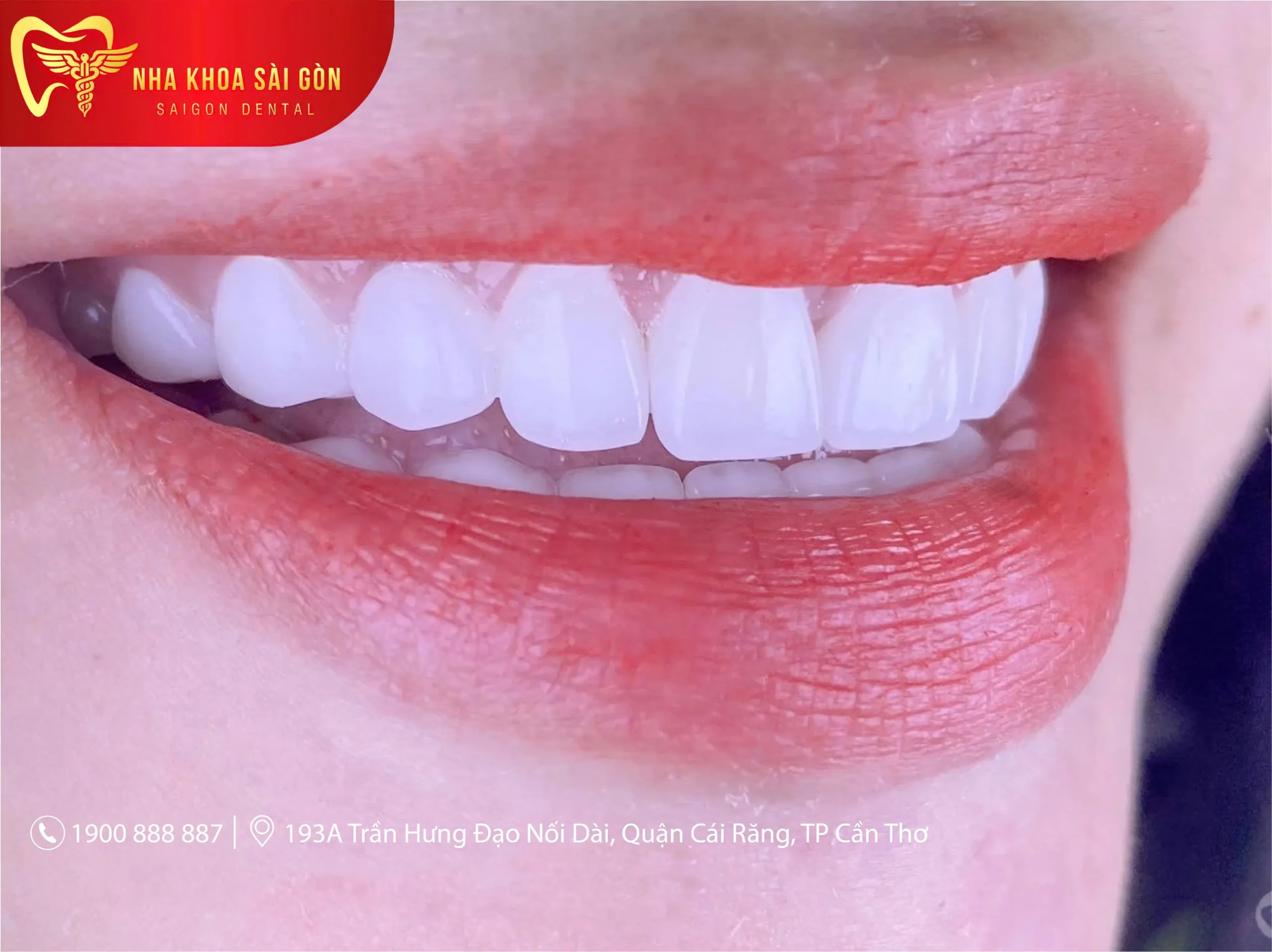 Răng sứ thẩm mỹ