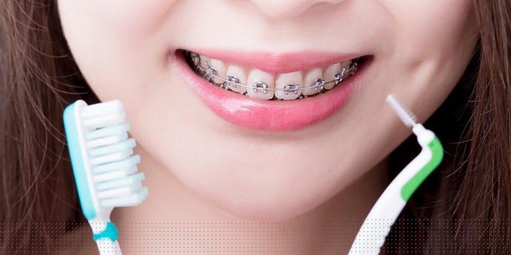 Hướng Dẫn Chăm Sóc Sau Niềng Răng