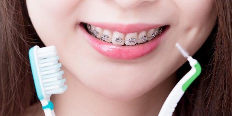 Hướng Dẫn Chăm Sóc Sau Niềng Răng