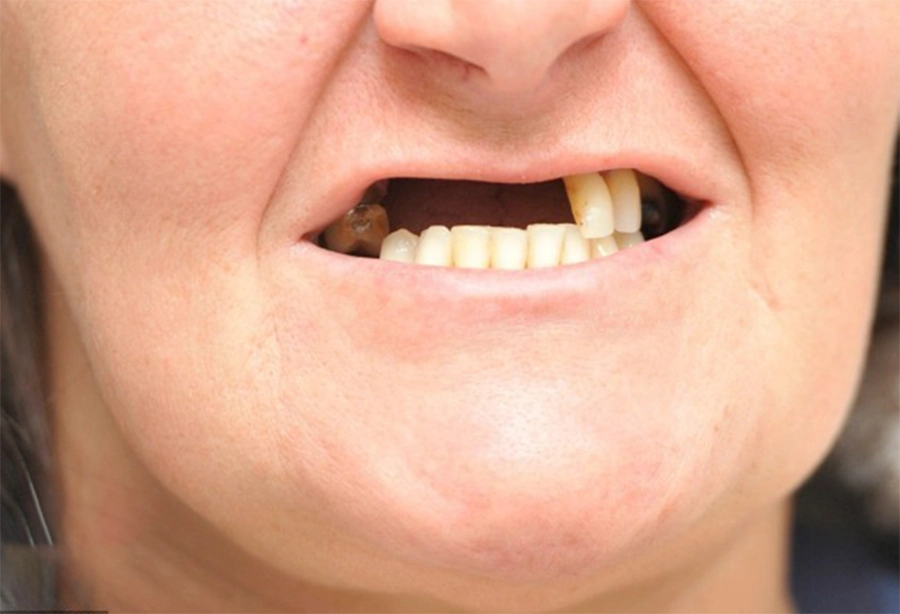 Giải Pháp Implant Cho Người Bị Mất Răng Toàn Hàm