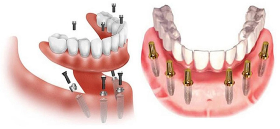Giải Pháp Implant Cho Người Bị Mất Răng Toàn Hàm