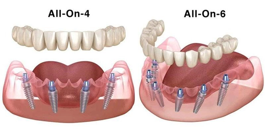 Giải Pháp Implant Cho Người Bị Mất Răng Toàn Hàm
