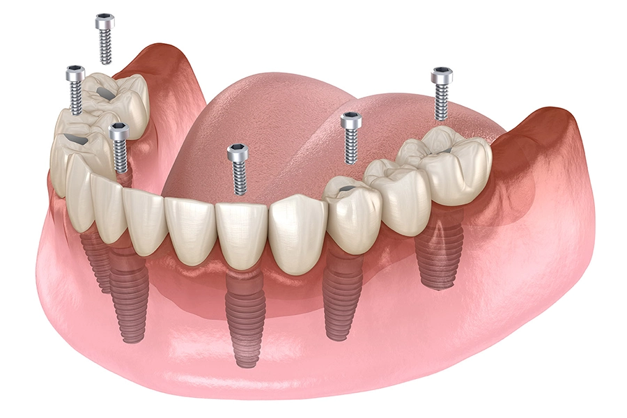 Giải Pháp Implant Cho Người Bị Mất Răng Toàn Hàm