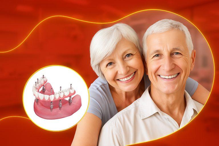 All 4, All 6 Implant Giải Pháp Trọn Vẹn Cho Cô Chú Mất Răng Toàn Hàm