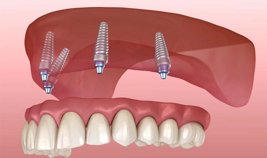 Giải Pháp Implant Cho Người Bị Mất Răng Toàn Hàm