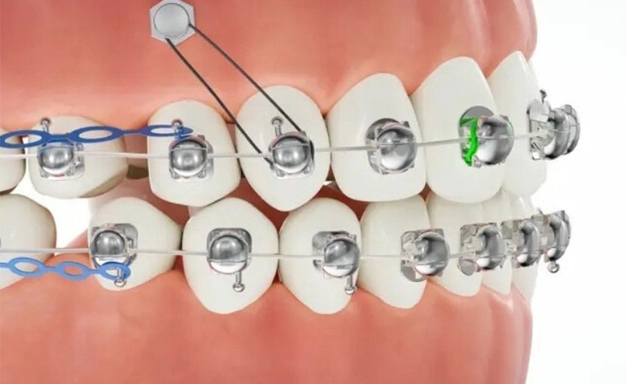 Công nghệ mắc cài cánh cam có ưu điểm gì