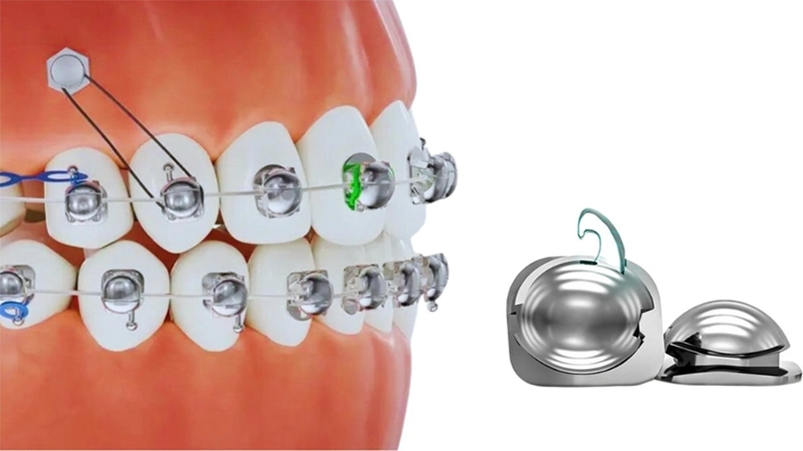 Công nghệ mắc cài cánh cam có ưu điểm gì