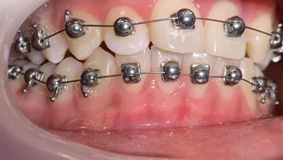 Công nghệ mắc cài cánh cam có ưu điểm gì