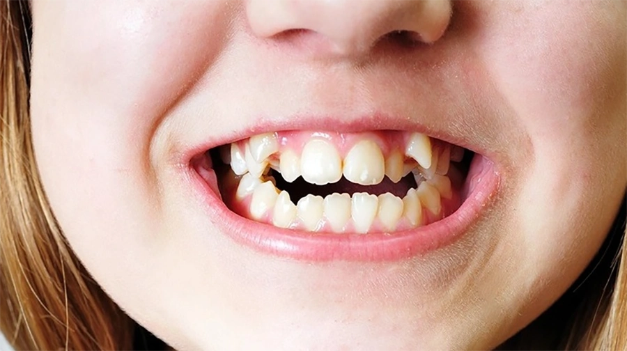 Công nghệ mắc cài cánh cam có ưu điểm gì