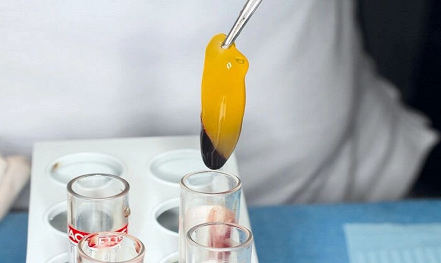 Công Nghệ Nhổ Răng Ghép PRF Nhanh Lành Thương Đã Có Tại Hệ Thống Nha Khoa Sài Gòn 3M