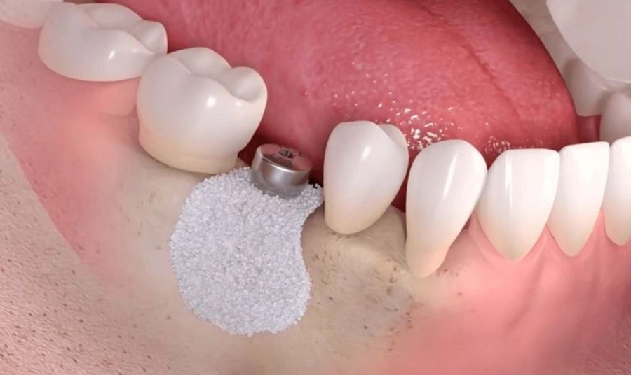 Công Nghệ Nhổ Răng Ghép PRF Nhanh Lành Thương Đã Có Tại Hệ Thống Nha Khoa Sài Gòn 3M