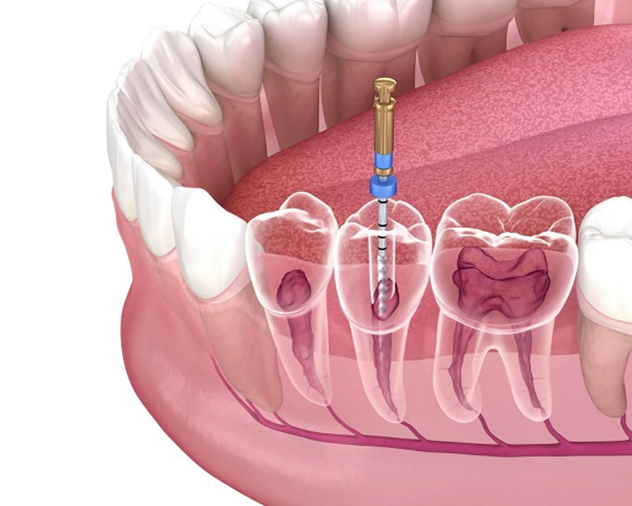 Công nghệ X-quang cận chóp và định vị chóp tủy giúp chữa tủy chính xác đến 99.9%.