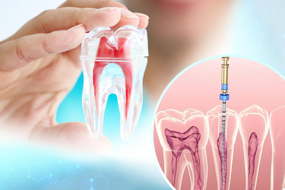 Điều Trị Tủy Răng: Giải Pháp An Toàn và Hiệu Quả Cho Nụ Cười Của Bạn Tại Nha Khoa Sài Gòn 3M
