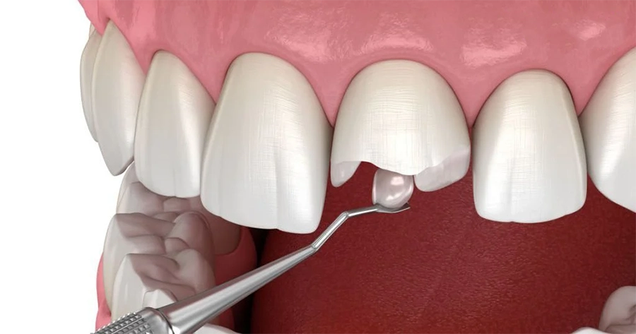Hàn Trám Răng: Giải Pháp An Toàn và Hiệu Quả
