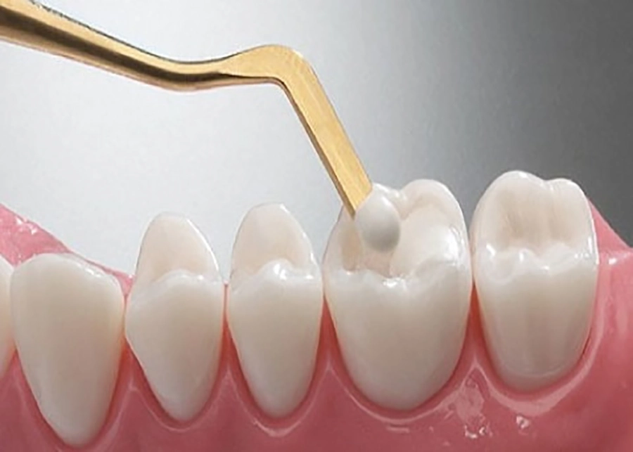Hàn Trám Răng: Giải Pháp An Toàn và Hiệu Quả Cho Nụ Cười Của Bạn