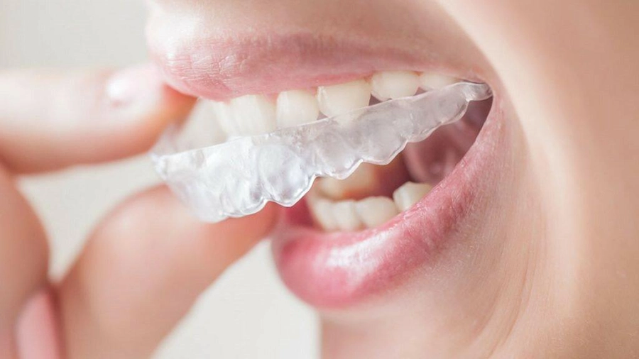 Niềng Răng Không Mắc Cài