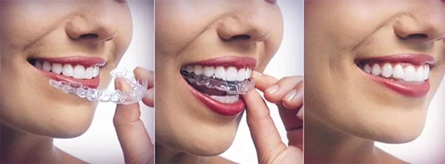 Niềng Răng Không Mắc Cài
