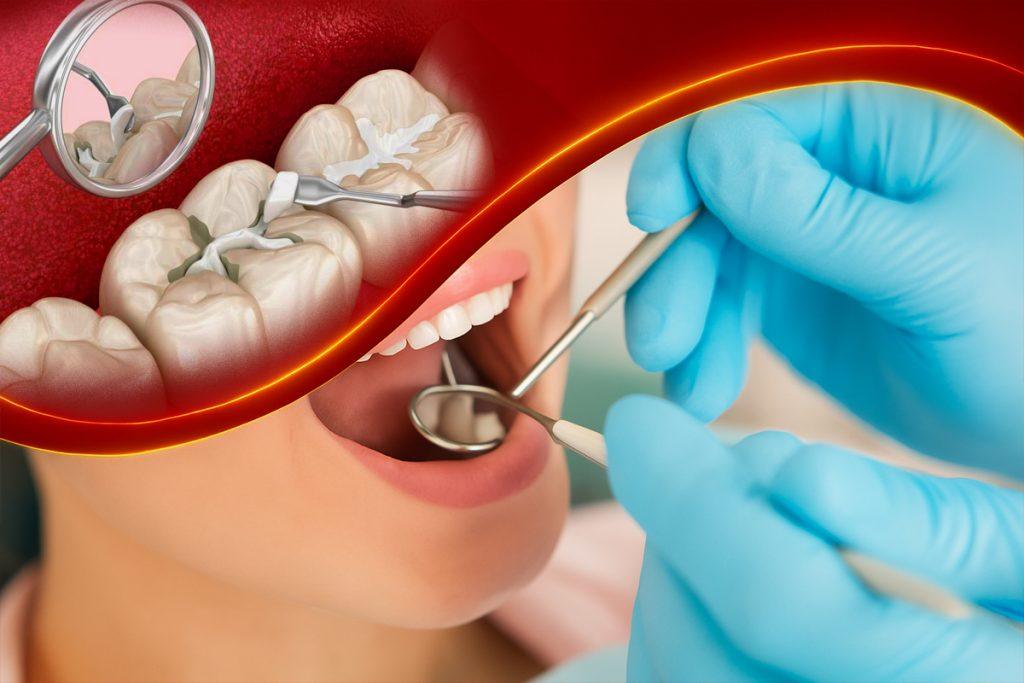Trám Răng Thẩm Mỹ Với Vật Liệu Chuẩn Châu Âu