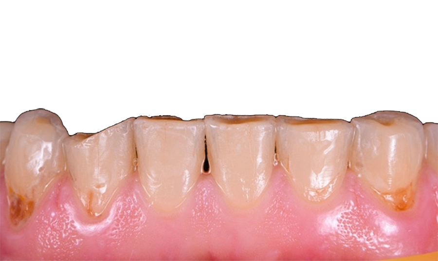Trám Răng Thẩm Mỹ Với Vật Liệu Chuẩn Châu Âu