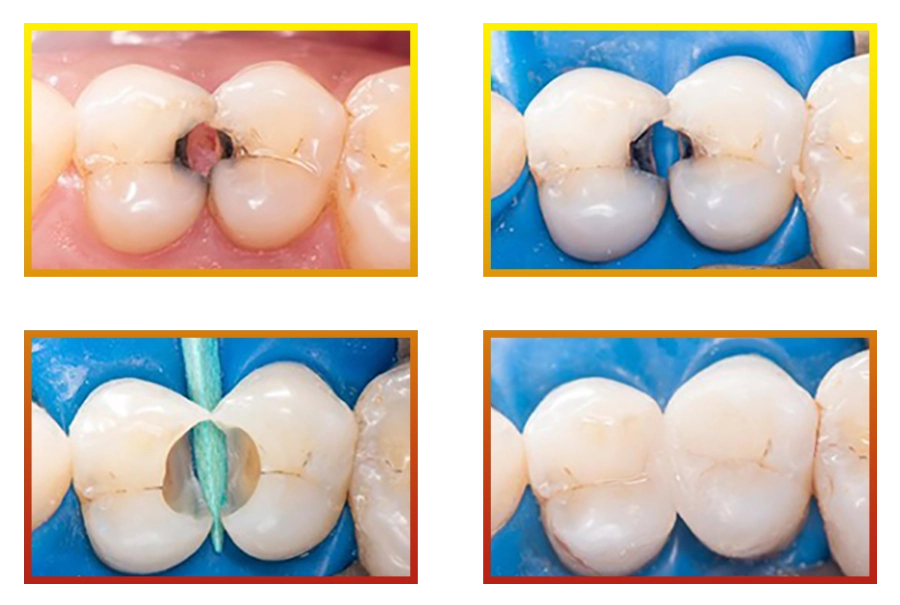 Trám Răng Thẩm Mỹ Với Vật Liệu Chuẩn Châu Âu