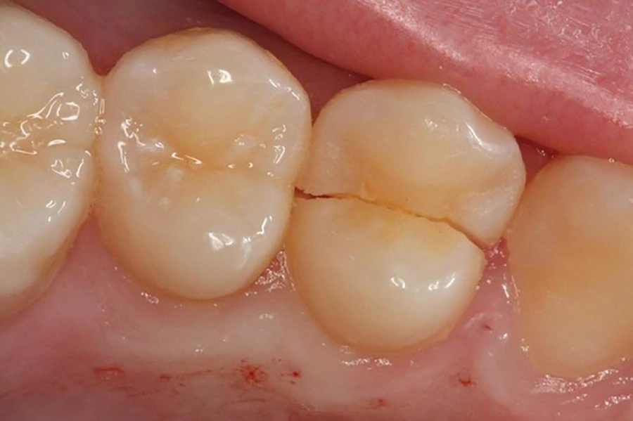 Trám Răng Thẩm Mỹ Với Vật Liệu Chuẩn Châu Âu