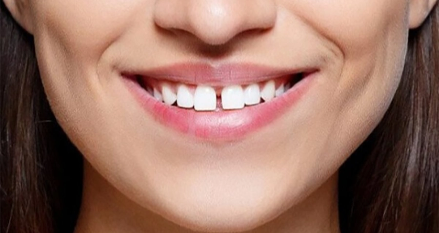 Trám Răng Thẩm Mỹ Với Vật Liệu Chuẩn Châu Âu