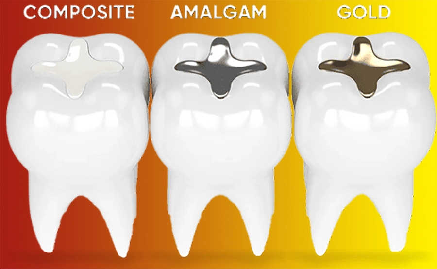 Trám Răng Thẩm Mỹ Với Vật Liệu Chuẩn Châu Âu