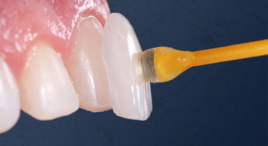 Trám Răng Thẩm Mỹ Với Vật Liệu Chuẩn Châu Âu