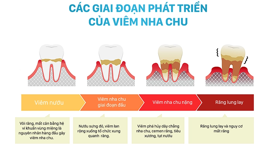 Viêm nha chu