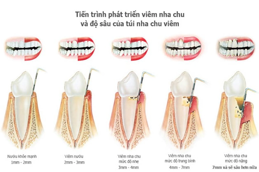 Viêm nha chu