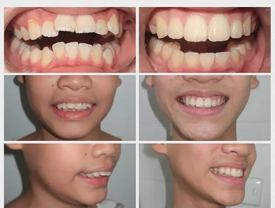 5 Lý Do Vàng Học Sinh, Sinh Viên Cần Niềng Răng Sớm Để Tỏa Sáng Nụ Cười