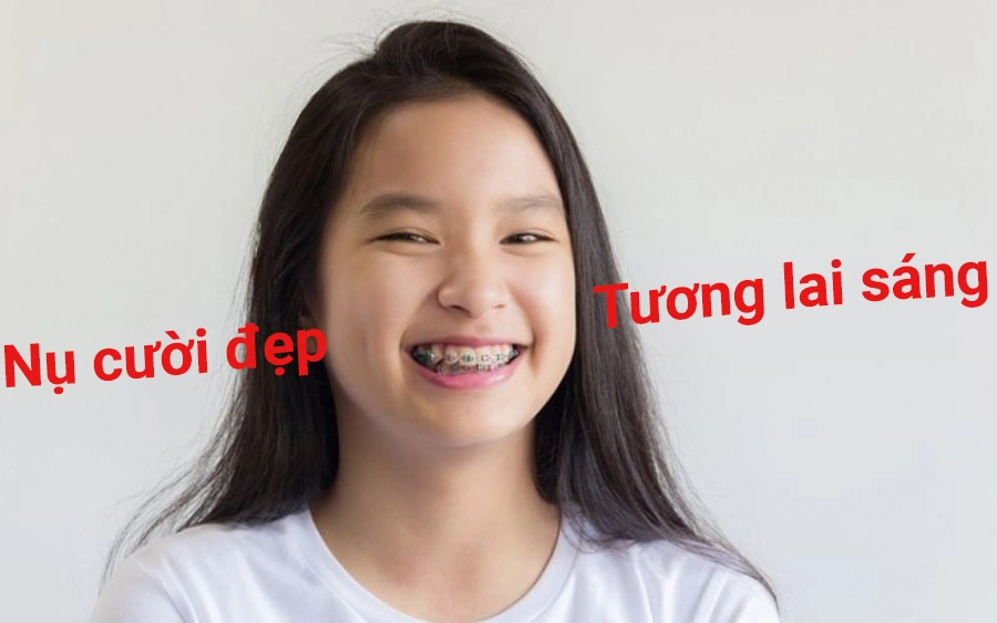 5 Lý Do Vàng Học Sinh, Sinh Viên Cần Niềng Răng Sớm Để Tỏa Sáng Nụ Cười