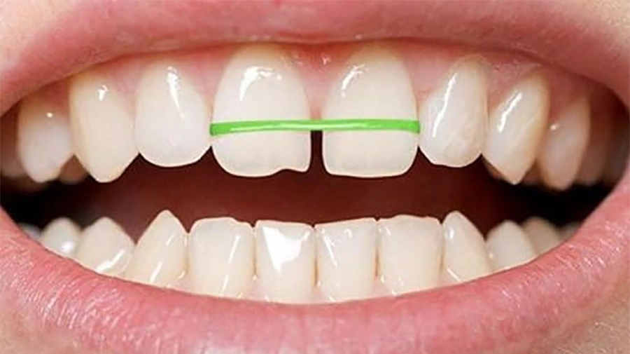 Các Sai Lầm Phổ Biến Khi Tự Ý Niềng Răng Tại Nhà Và Cách Tránh