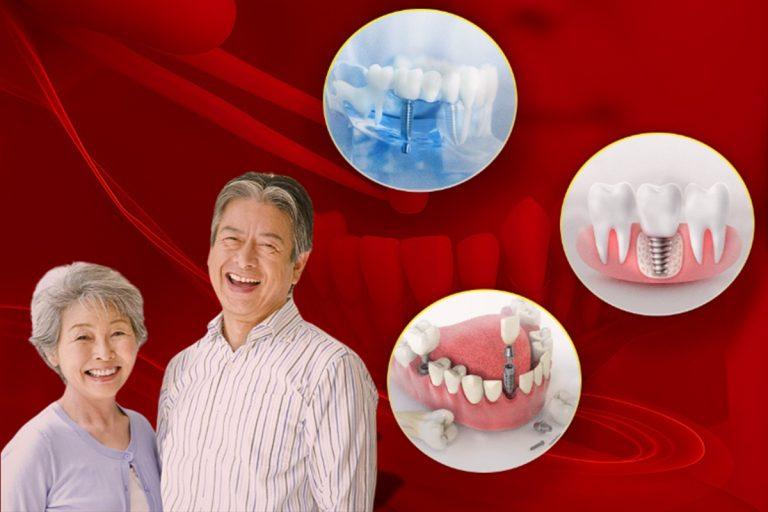 Cấy Ghép Implant Cho Người Lớn Tuổi: Bí Quyết Nụ Cười Vẫn Đẹp