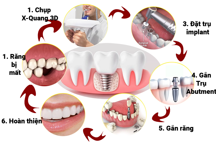 Cấy Ghép Implant Cho Người Lớn Tuổi: Bí Quyết Nụ Cười Vẫn Đẹp