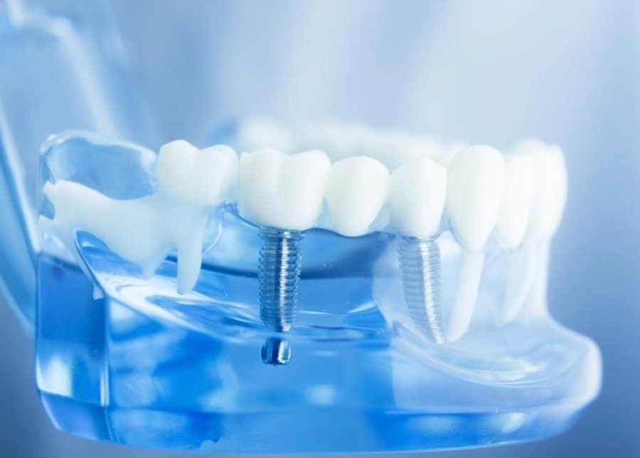 Cấy Ghép Implant Cho Người Lớn Tuổi: Bí Quyết Nụ Cười Vẫn Đẹp