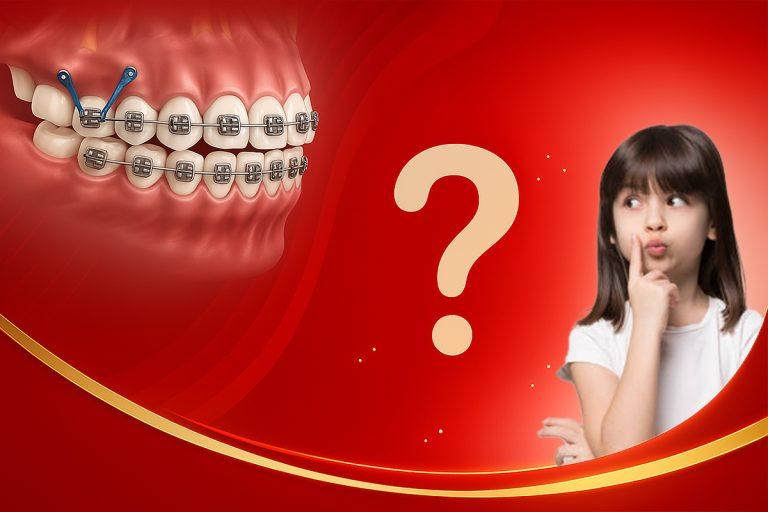 Niềng Răng Có Thực Sự Đau? Giải Mã Nỗi Lo Của Bạn
