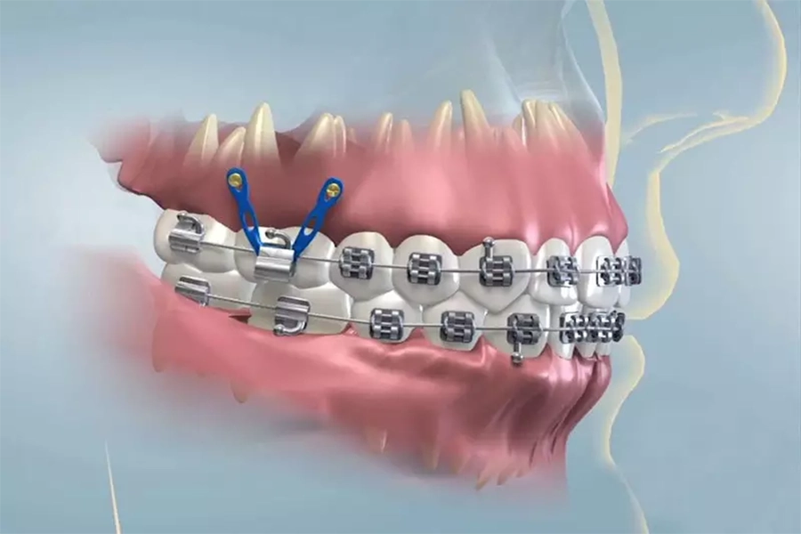 Niềng Răng Có Thực Sự Đau? Giải Mã Nỗi Lo Của Bạn