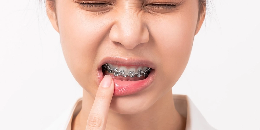 Niềng Răng Có Thực Sự Đau? Giải Mã Nỗi Lo Của Bạn