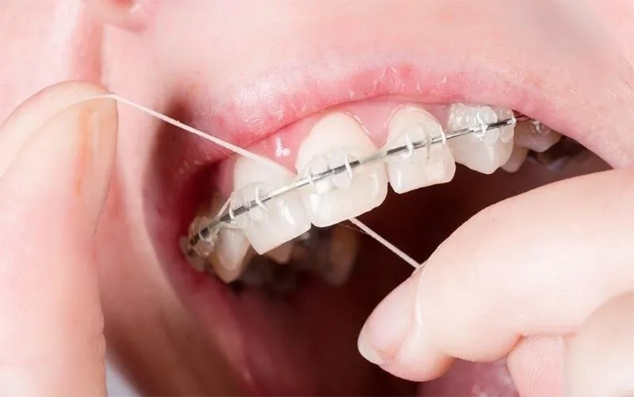 Niềng Răng Mắc Cài Kim Loại vs Mắc Cài Sứ: Sự Khác Biệt Bạn Cần Biết