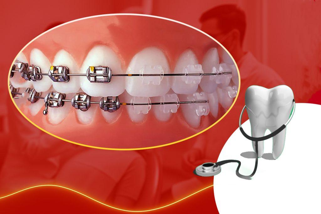 Niềng Răng Mắc Cài Kim Loại vs Mắc Cài Sứ: Sự Khác Biệt Bạn Cần Biết