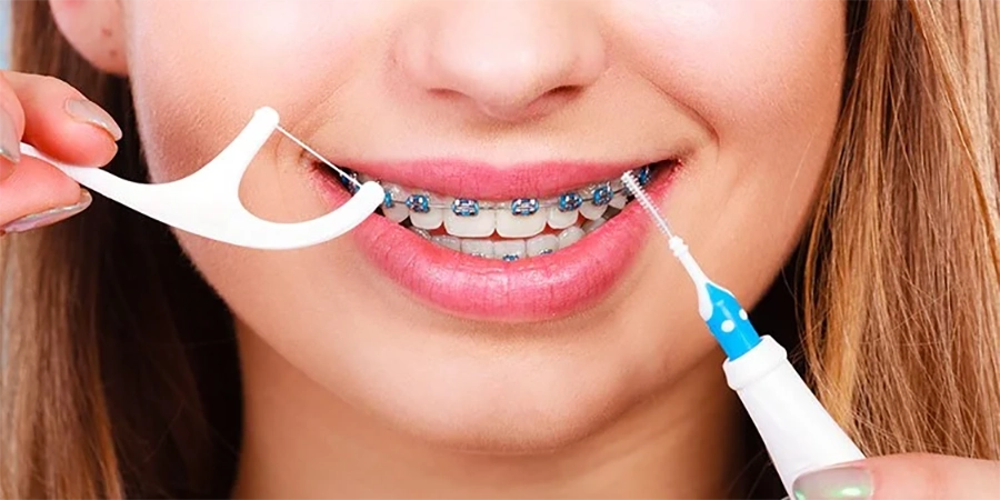 Niềng Răng Mắc Cài Kim Loại vs Mắc Cài Sứ: Sự Khác Biệt Bạn Cần Biết